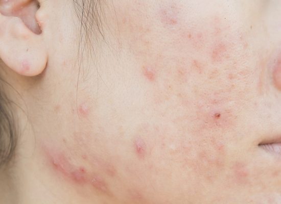 acne-scar-face-skin-problem 800-min